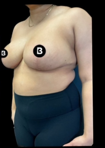 Breast Reduction Before and After Pictures in Buffalo, NY