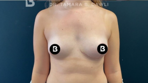 Breast Reduction Before and After Pictures in Buffalo, NY
