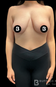 Breast Reduction Before and After Pictures in Buffalo, NY
