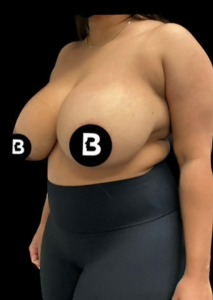 Breast Reduction Before and After Pictures in Buffalo, NY