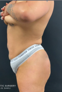 Brazilian Butt Lift Before and After Pictures in Buffalo, NY