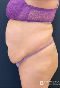 Brazilian Butt Lift Before and After Pictures in Buffalo, NY