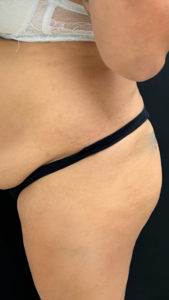 Brazilian Butt Lift Before and After Pictures in Buffalo, NY