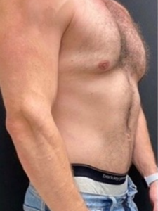 Abdominoplasty (Tummy Tuck) Before and After Pictures in Buffalo, NY