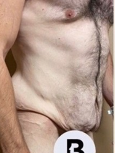 Abdominoplasty (Tummy Tuck) Before and After Pictures in Buffalo, NY
