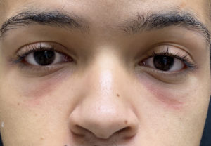 Tear Trough Fillers Before and After Pictures in Buffalo, NY