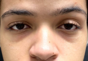 Tear Trough Fillers Before and After Pictures in Buffalo, NY