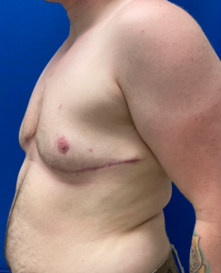 Female to Male Top Surgery Before and After Pictures in Buffalo, NY