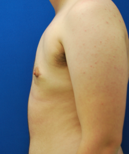 Female to Male Top Surgery Before and After Pictures in Buffalo, NY