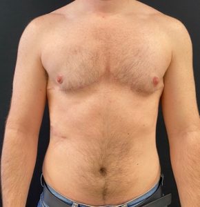 Female to Male Top Surgery Before and After Pictures in Buffalo, NY