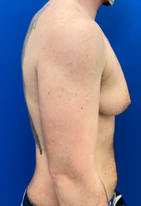 Female to Male Top Surgery Before and After Pictures in Buffalo, NY