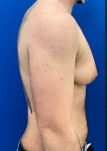 Female to Male Top Surgery Before and After Pictures in Buffalo, NY