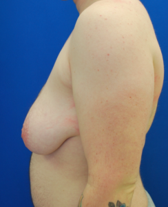 Female to Male Top Surgery Before and After Pictures in Buffalo, NY