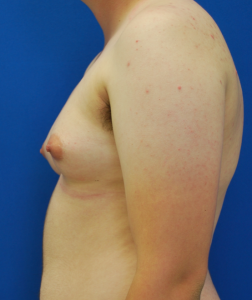 Female to Male Top Surgery Before and After Pictures in Buffalo, NY