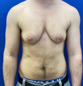 Female to Male Top Surgery Before and After Pictures in Buffalo, NY