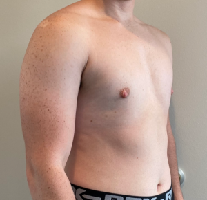 Female to Male Top Surgery Before and After Pictures in Buffalo, NY