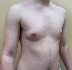 Female to Male Top Surgery Before and After Pictures in Buffalo, NY