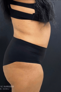 Abdominoplasty (Tummy Tuck) Before and After Pictures in Buffalo, NY