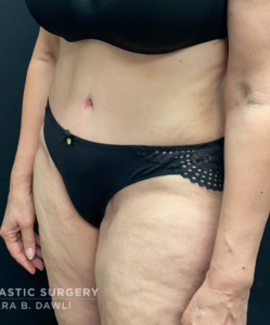 Abdominoplasty (Tummy Tuck) Before and After Pictures in Buffalo, NY