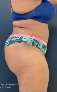 Abdominoplasty (Tummy Tuck) Before and After Pictures in Buffalo, NY