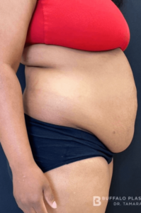 Abdominoplasty (Tummy Tuck) Before and After Pictures in Buffalo, NY