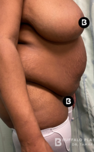 Abdominoplasty (Tummy Tuck) Before and After Pictures in Buffalo, NY