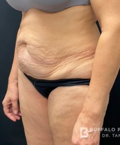 Abdominoplasty (Tummy Tuck) Before and After Pictures in Buffalo, NY
