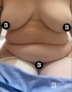 Abdominoplasty (Tummy Tuck) Before and After Pictures in Buffalo, NY