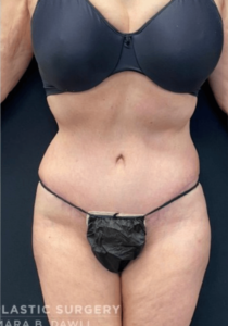Abdominoplasty (Tummy Tuck) Before and After Pictures in Buffalo, NY