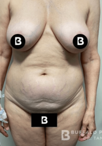 Abdominoplasty (Tummy Tuck) Before and After Pictures in Buffalo, NY