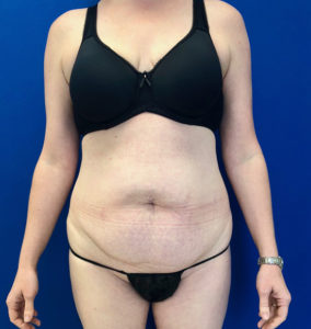 Abdominoplasty (Tummy Tuck) Before and After Pictures Buffalo, NY