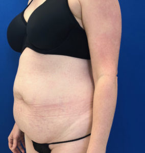 Abdominoplasty (Tummy Tuck) Before and After Pictures Buffalo, NY