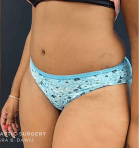 Abdominoplasty (Tummy Tuck) Before and After Pictures in Buffalo, NY