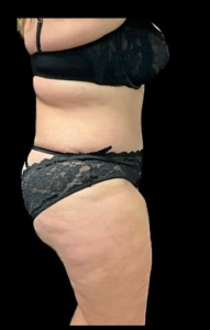 Abdominoplasty (Tummy Tuck) Before and After Pictures in Buffalo, NY