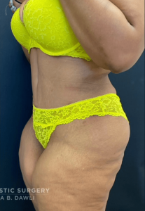 Abdominoplasty (Tummy Tuck) Before and After Pictures in Buffalo, NY