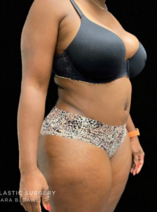 Abdominoplasty (Tummy Tuck) Before and After Pictures in Buffalo, NY