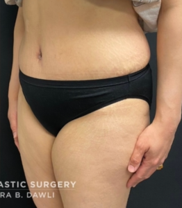 Abdominoplasty (Tummy Tuck) Before and After Pictures in Buffalo, NY
