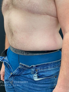 Abdominoplasty (Tummy Tuck) Before and After Pictures in Buffalo, NY