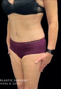 Abdominoplasty (Tummy Tuck) Before and After Pictures in Buffalo, NY