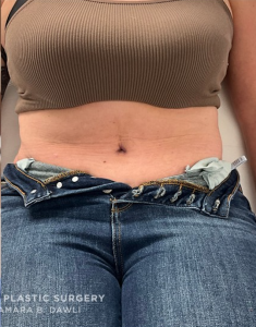 Abdominoplasty (Tummy Tuck) Before and After Pictures in Buffalo, NY