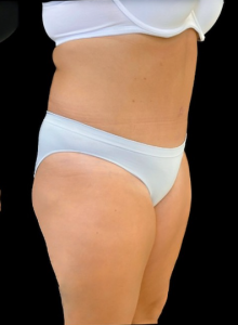 Abdominoplasty (Tummy Tuck) Before and After Pictures in Buffalo, NY