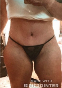 Abdominoplasty (Tummy Tuck) Before and After Pictures in Buffalo, NY