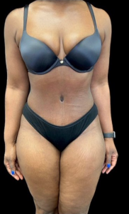 Abdominoplasty (Tummy Tuck) Before and After Pictures in Buffalo, NY