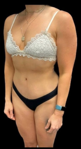 Abdominoplasty (Tummy Tuck) Before and After Pictures in Buffalo, NY
