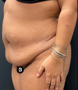 Abdominoplasty (Tummy Tuck) Before and After Pictures in Buffalo, NY