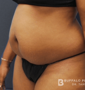 Abdominoplasty (Tummy Tuck) Before and After Pictures in Buffalo, NY