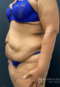 Abdominoplasty (Tummy Tuck) Before and After Pictures in Buffalo, NY