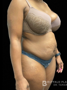 Abdominoplasty (Tummy Tuck) Before and After Pictures in Buffalo, NY