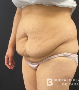 Abdominoplasty (Tummy Tuck) Before and After Pictures in Buffalo, NY