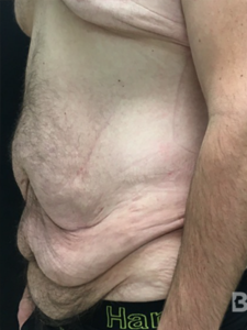 Abdominoplasty (Tummy Tuck) Before and After Pictures in Buffalo, NY